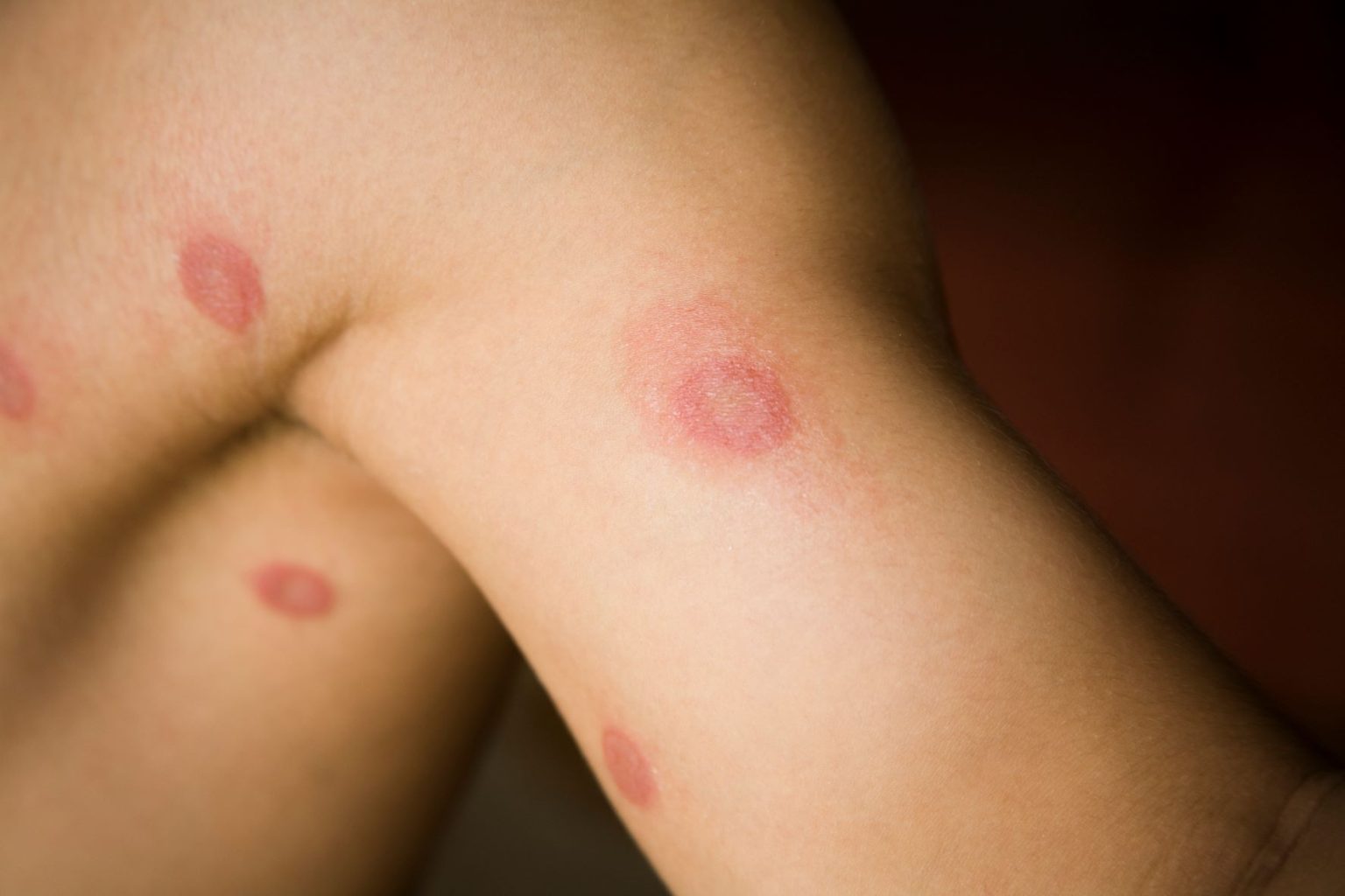 How Contagious is Ringworm from Cats to Humans: Discover the Facts - Cats