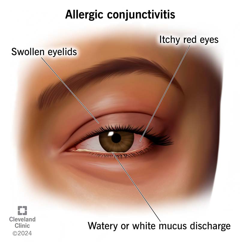 How to Treat Swollen Eye from Cat Allergy