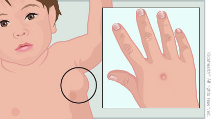 Is Cat Scratch Disease Contagious
