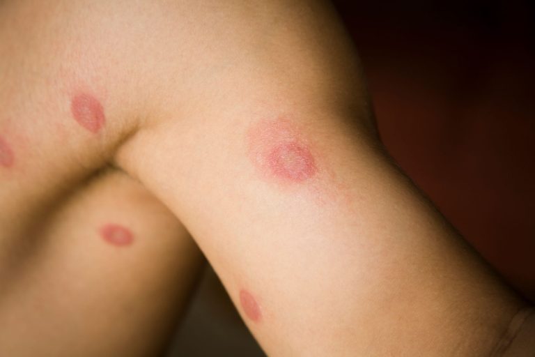 Is Ringworm in Cats Contagious to Humans
